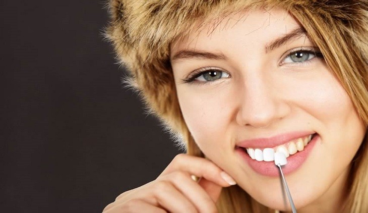 carillas-dentales